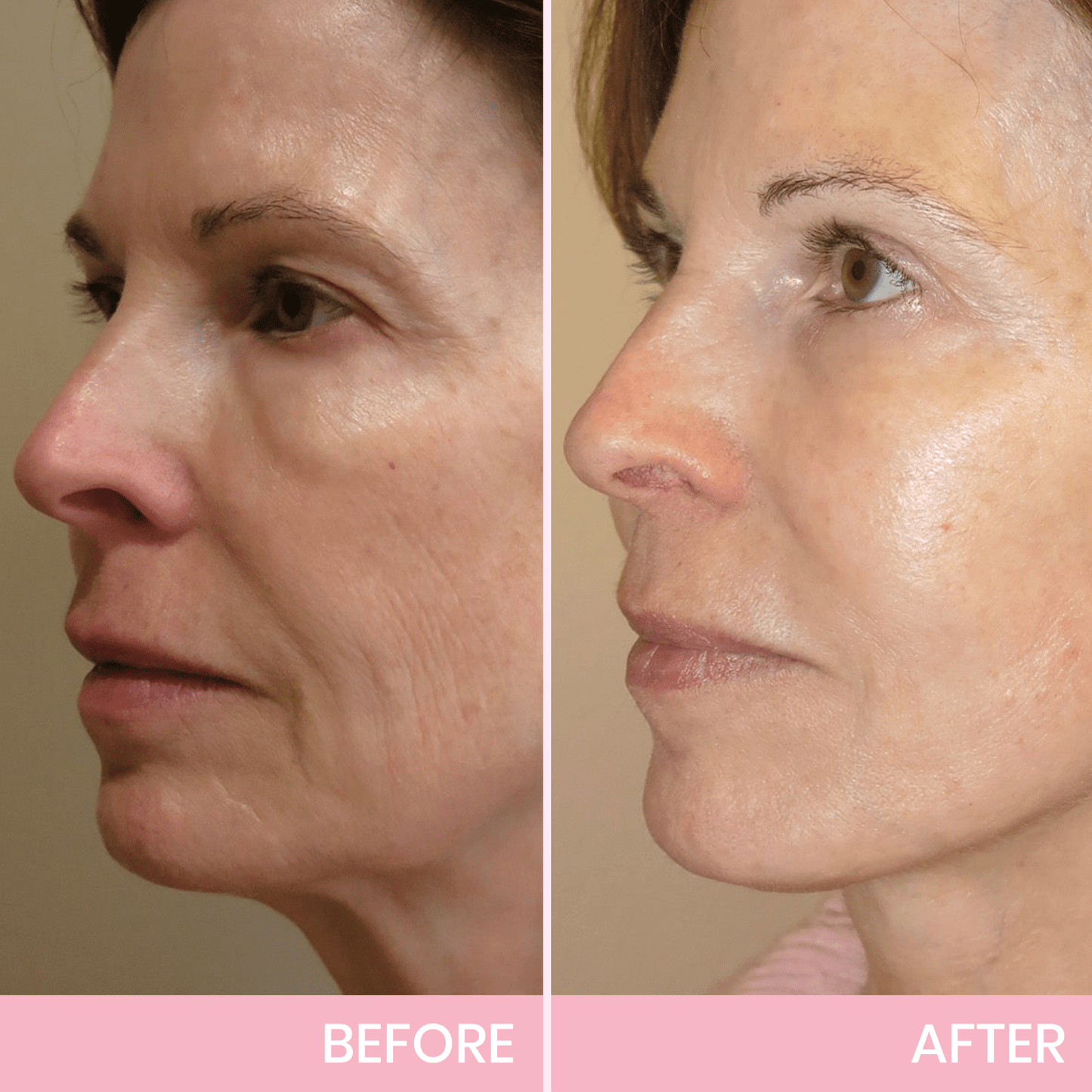 V-Lift Invisible – Le secret d'un visage sculpté en un instant