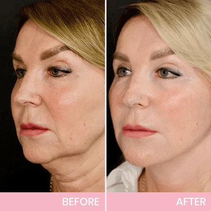 V-Lift Invisible – Le secret d'un visage sculpté en un instant