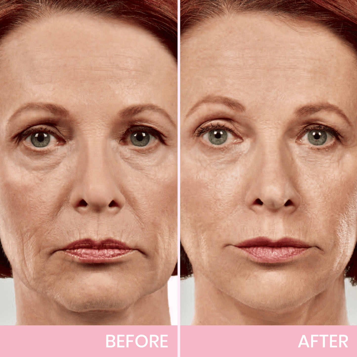 V-Lift Invisible – Le secret d'un visage sculpté en un instant