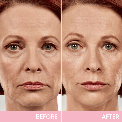 V-Lift Invisible – Le secret d'un visage sculpté en un instant