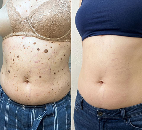 SkinRenew – Le soin naturel anti-acrochordons et verrues