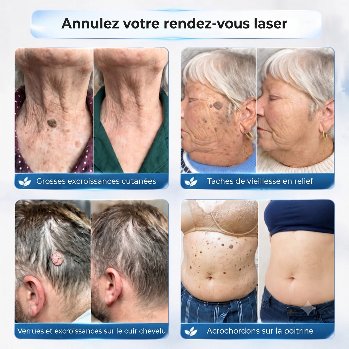 SkinRenew – Le soin naturel anti-acrochordons et verrues